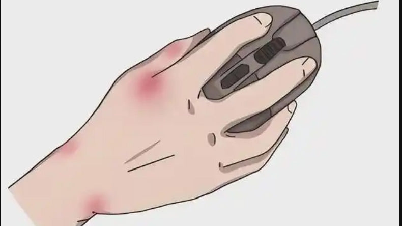 Severe mouse hands can lead to permanent disability! 5 points for relief!
